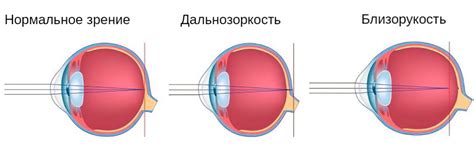 Дальнозоркость: почему происходит исчезновение глазного яблока?