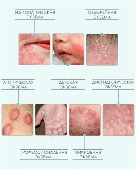 Дерматиты и экземы: причины и виды