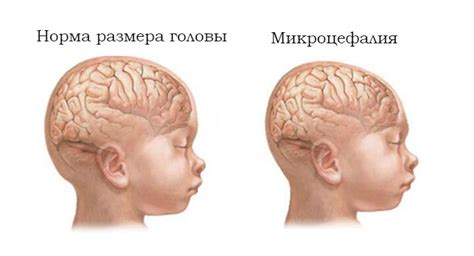 Детская микроцефалия: симптомы и рекомендации