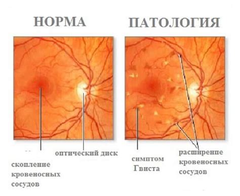 Диабетическая ангиопатия: принципы и методы лечения