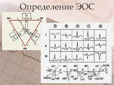 Диагностика ЭОС тип S на ЭКГ