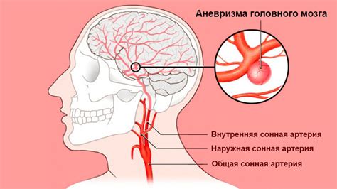 Диагностика аневризмы сосудов головного мозга