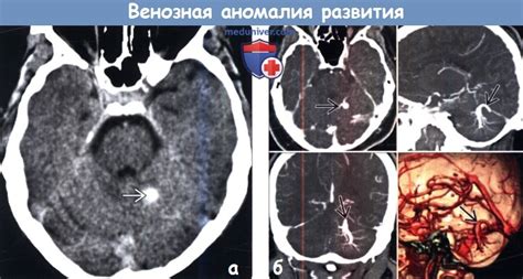 Диагностика венозной аномалии развития головного мозга