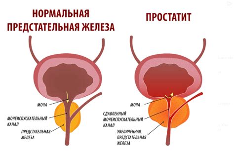 Диагностика воспаления простаты