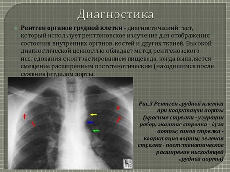 Диагностика гипоплазии перешейка аорты