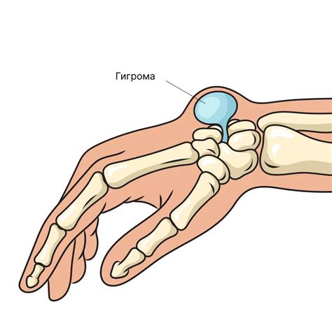 Диагностика и лечение воспаления косточки на запястье