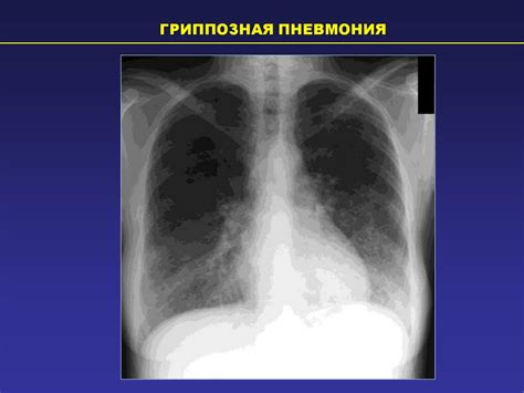 Диагностика и лечение секундарных изменений в легких