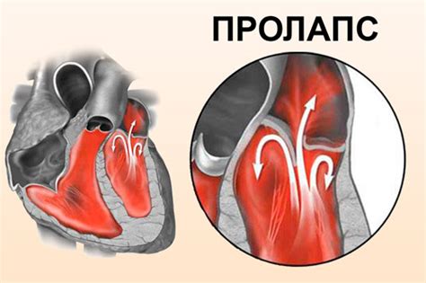 Диагностика и лечение эктопического крепления хорд митрального клапана