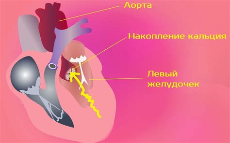 Диагностика кальциноза аорты и коронарных сосудов