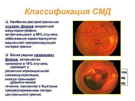 Диагностика макулодистрофии сетчатки