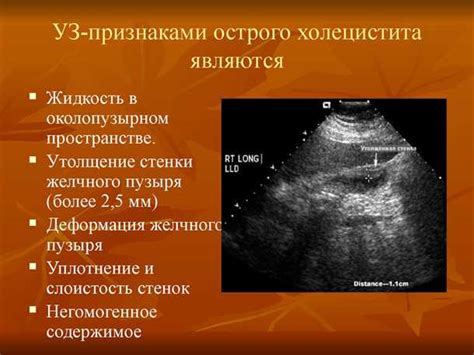 Диагностика неравномерного утолщения стенок желчного пузыря