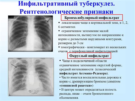 Диагностика обызвествленного очага в легких