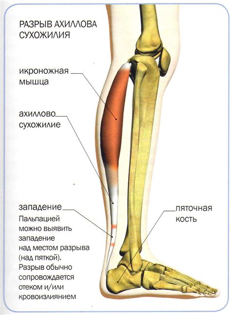 Диагностика повреждения сухожилия