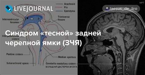 Диагностика синдрома тесной задней черепной ямки