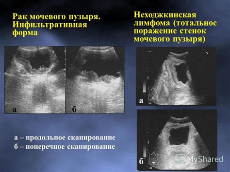 Диагностика утолщения стенок мочевого пузыря