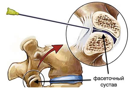 Диагностика фасеточного синдрома шейного отдела