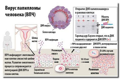 Дисплазия у мужчин при ВПЧ