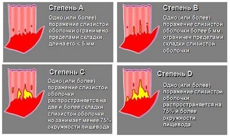 Дистальный катаральный эзофагит