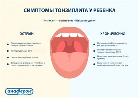 Длительность проявления острого стрептококкового тонзиллита у детей