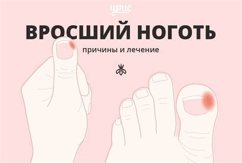 Домашние методы лечения утолщенного ногтя