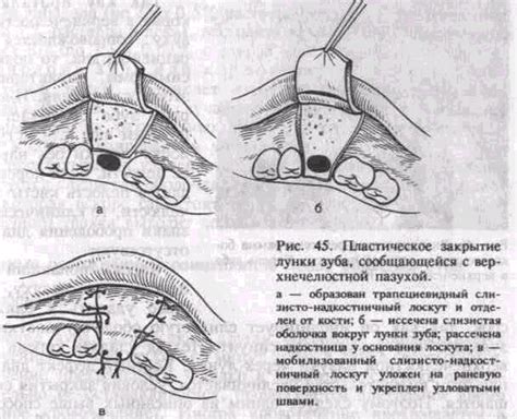 Дренирование сгустка