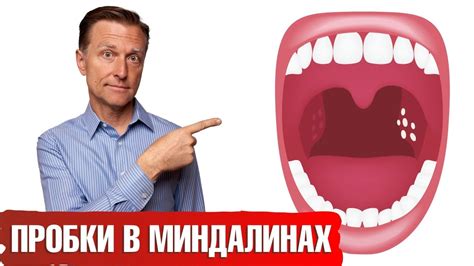 Еда, которую следует избегать при гнойниках на миндалинах