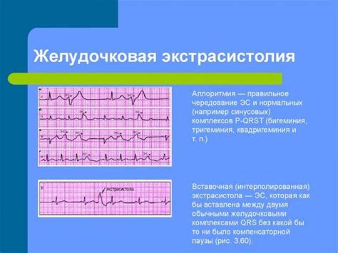 Желудочковая экстрасистолия: причины, симптомы и лечение