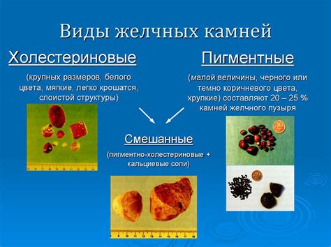 Желчнокаменная болезнь и образование камней