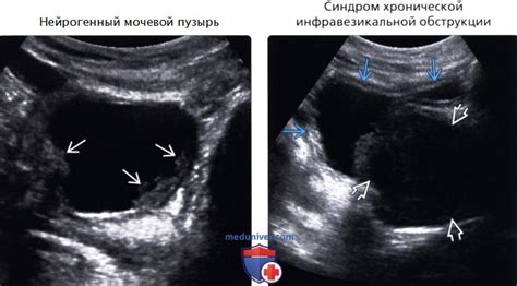 Заболевания, вызывающие утолщение стенок мочевого пузыря