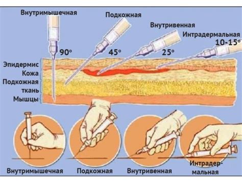 Завершение процедуры инъекции в бедро