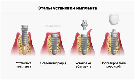 Закрепление и фиксация бусин