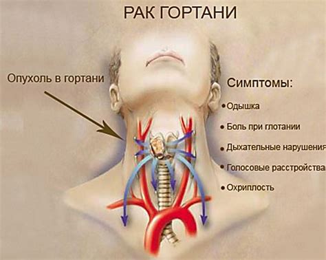 Злокачественные опухоли и рак гортани