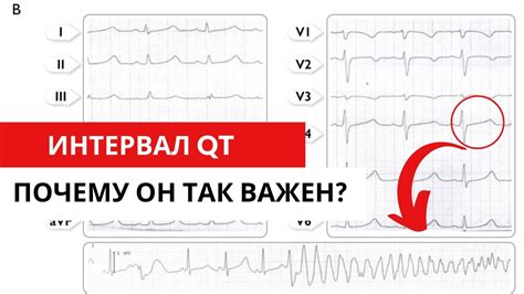 Значение корригированного интервала QT в диагностике заболеваний