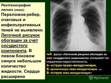 Значение сосудистого компонента в легочном рисунке