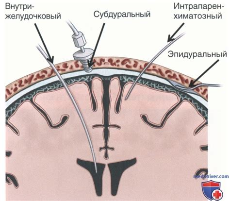 Значимость измерения внутричерепного давления