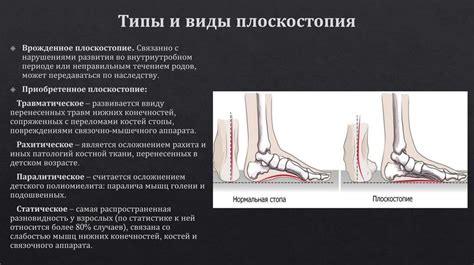 Избегаем плоскостопие: простые рекомендации