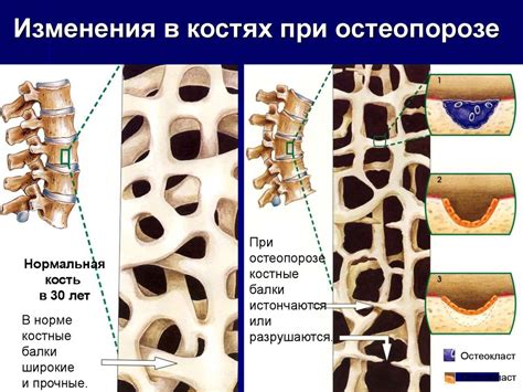 Изменения в костях