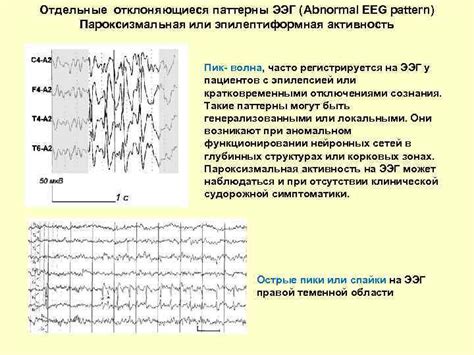 Изменения ирритативного характера на ЭЭГ