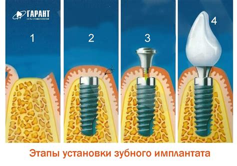 Имплантация оправы