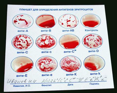 Интерпретация результатов определения группы крови по картинке