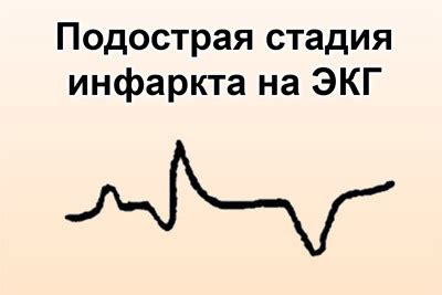 Инфаркт миокарда и его связь с неправильной реполяризацией