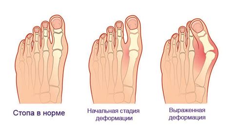 Какие методы лечения могут помочь при сломанном пальце на ноге?