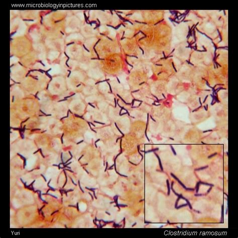 Какие причины повышения Clostridium ramosum в крови существуют?