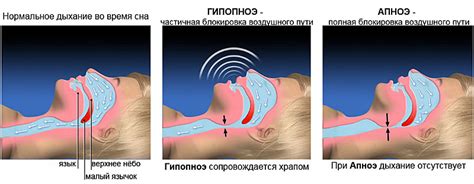 Какие симптомы обычно сопровождают синдром апноэ во время сна?