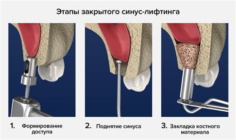 Какова цена синус лифтинга?