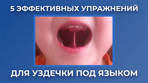 Каковы преимущества подрезания уздечки под языком?