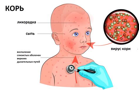 Как вирус кори передается в массы и что нужно знать об этом