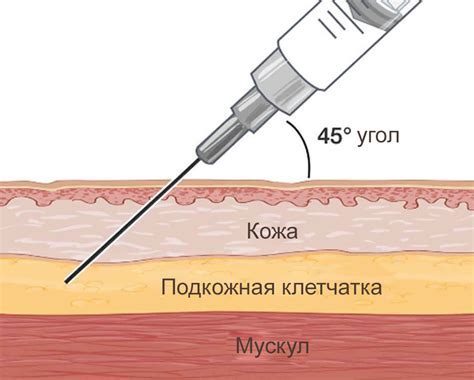 Как делать инъекцию шприцем ручкой: шаг за шагом