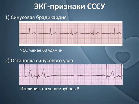 Как диагностируется синусовая брадиаритмия?