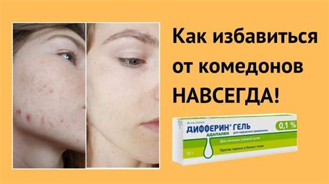 Как избавиться от закрытых комедонов на лице: лучшие методы